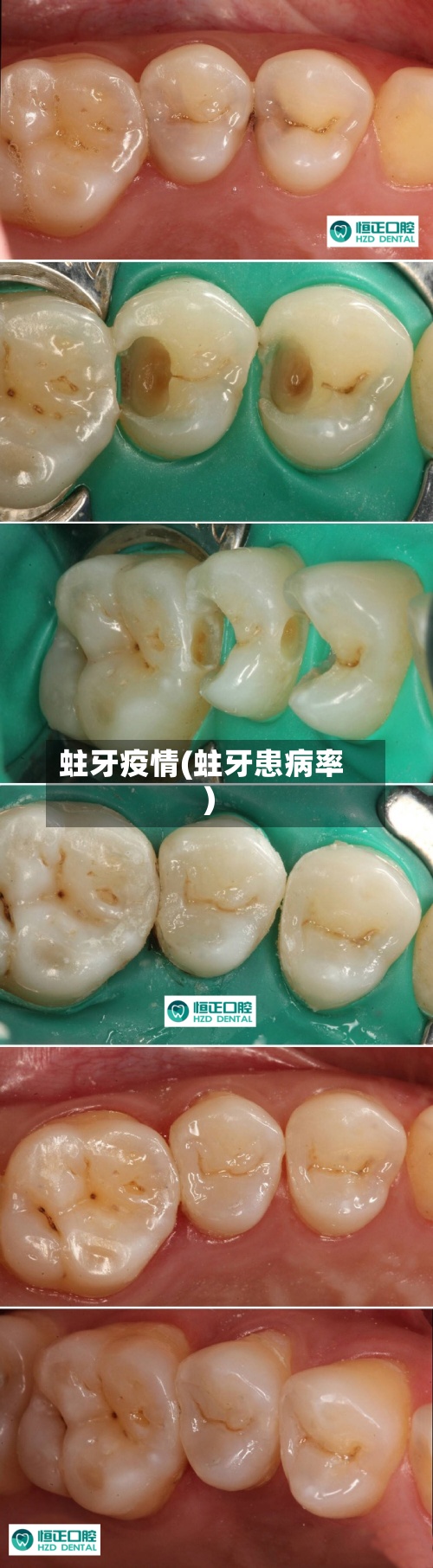 蛀牙疫情(蛀牙患病率)